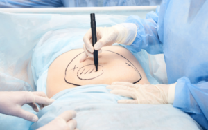 liposuction nedir